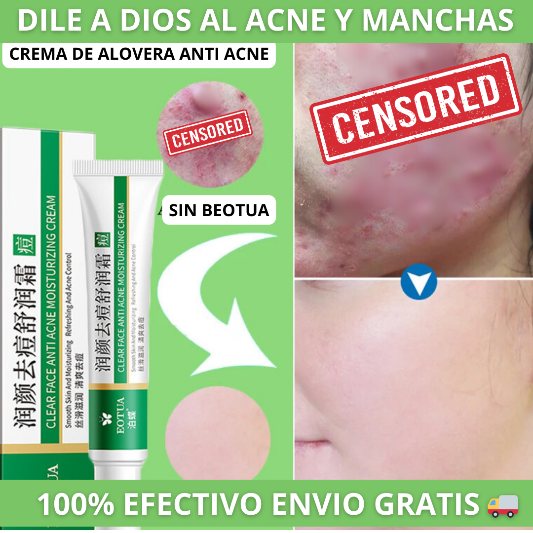 CREMA ANTIACNE DE ALOE VERA 100% EFECTIVO